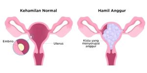 Apa Penyebab Dan Tanda Tanda Kehamilan Anggur